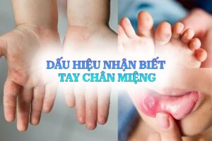 dấu hiệu tay chân miệng