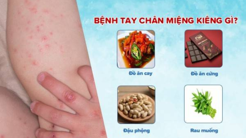 tay chân miệng kiêng gì