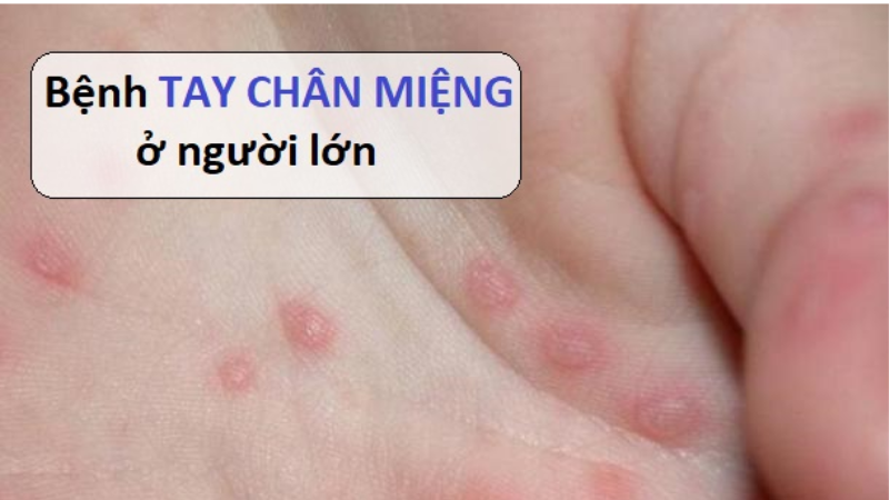 người lớn có bị tay chân miệng không