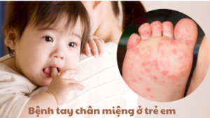 bệnh tay chân miệng ở trẻ em