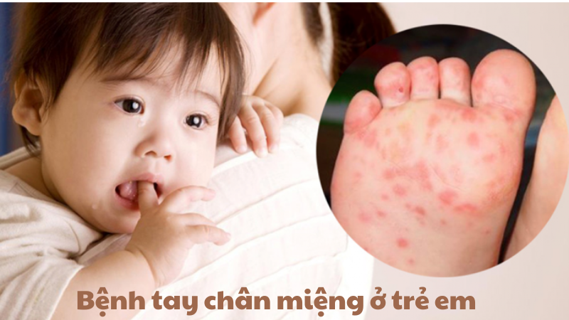 bệnh tay chân miệng ở trẻ em