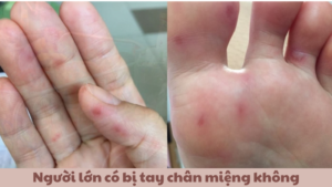 người lớn có bị tay chân miệng không