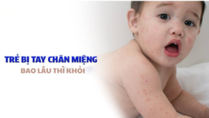 trẻ bị tay chân miệng bao lâu thì khỏi