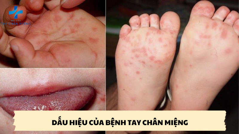 dấu hiệu của bệnh tay chân miệng