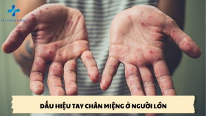 dấu hiệu tay chân miệng ở người lớn