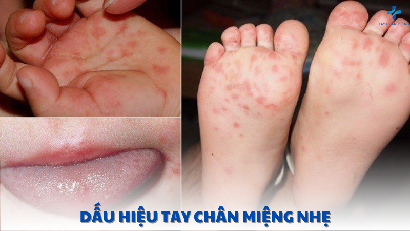 dấu hiệu tay chân miệng nhẹ