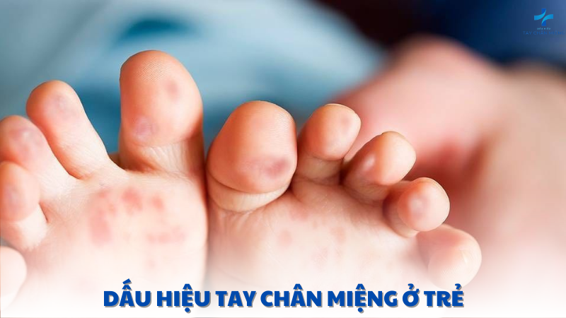 dấu hiệu tay chân miệng ở trẻ