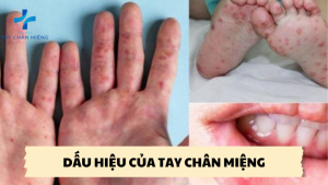 dấu hiệu của tay chân miệng