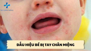 dấu hiệu bé bị tay chân miệng