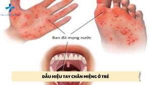 dấu hiệu tay chân miệng nhẹ ở trẻ