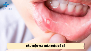 dấu hiệu tay chân miệng ở bé