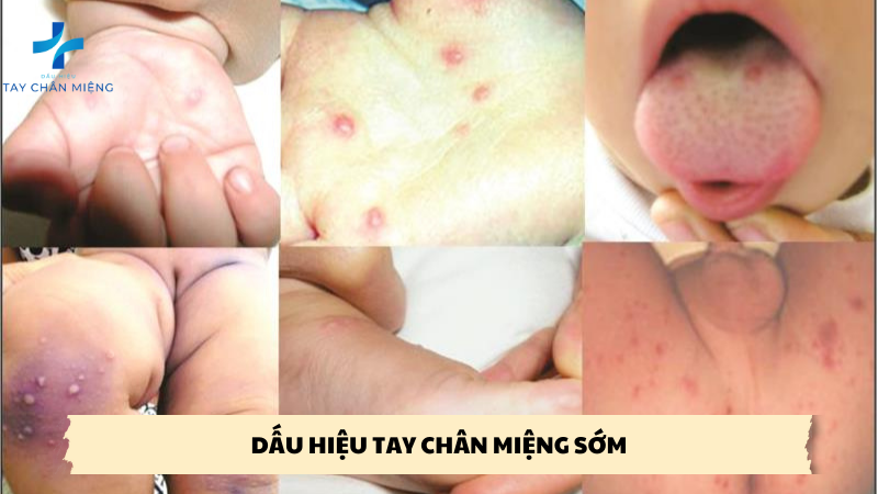 Dấu Hiệu Tay Chân Miệng Sớm